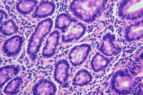 Celiachia, studio sull’ormone zonulina e uso non appropriato degli antibiotici nei primi mesi di vita