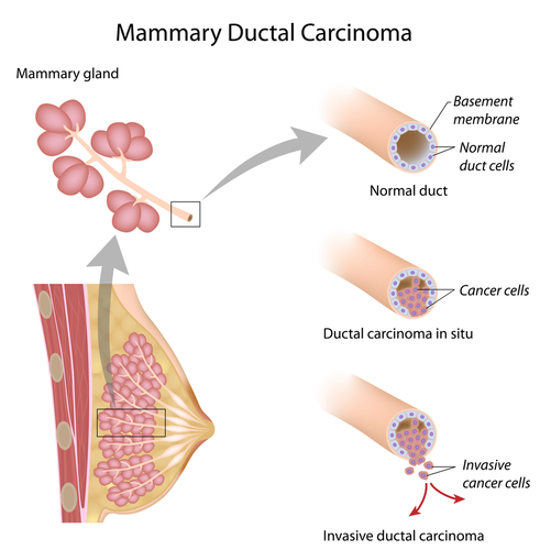 Carcinoma duttale in situ: quali pazienti possono omettere la radioterapia?
