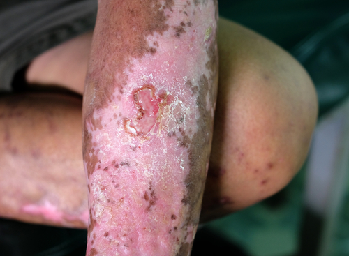 Ulcere digitali: le terapie tipiche non bastano