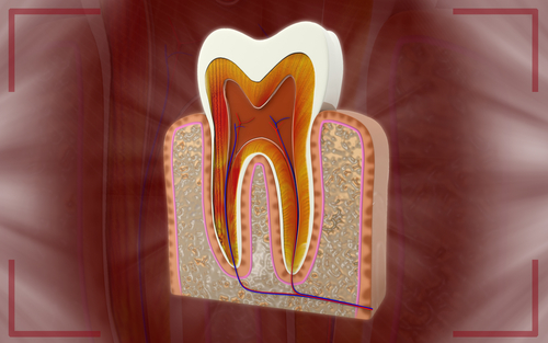 Pulpite irreversibile dei molari permanenti: efficace pulpotomia MTA