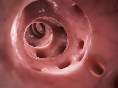 Diverticolite: troppi interventi in fase precoce