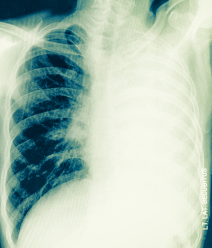 B2M: un regolatore dell’ipertensione polmonare nell’HFpEF