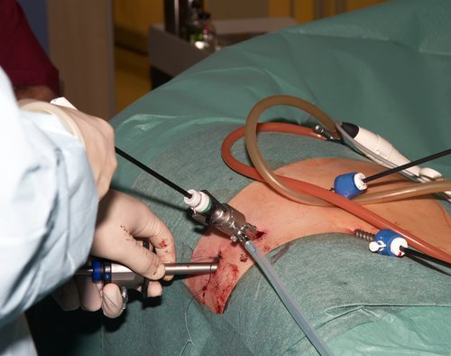 Tumore dello stomaco: laparoscopia efficace come la chirurgia tradizionale
