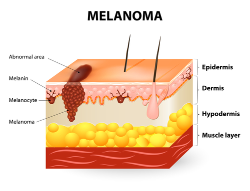 Melanoma stadio IV: vaccino a cellule dendritiche con IL-2 a basse dosi