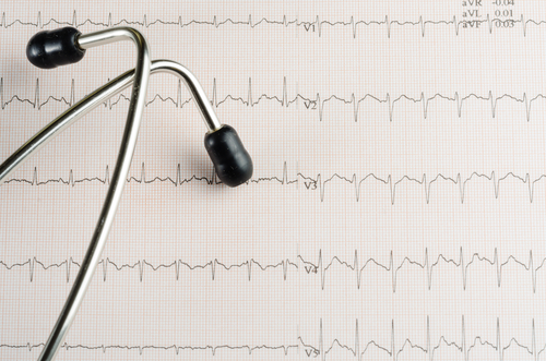 Tachicardia posturale associata a sindrome di Ehlers-Danlos: esercizio fisico efficace e sicuro