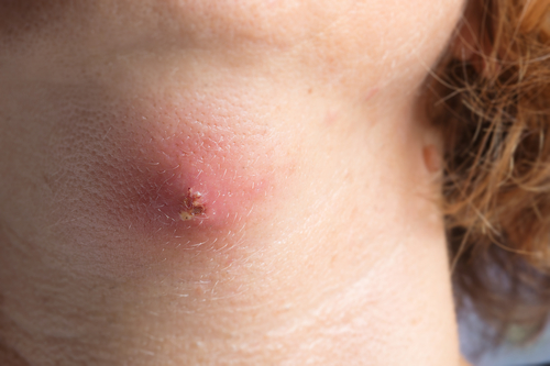 Ascessi cutanei: esiti migliorati con antibiotici post-drenaggio