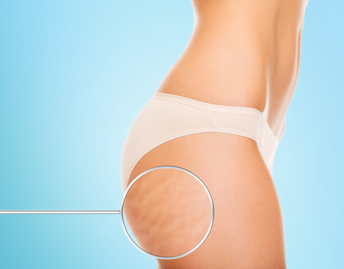 Nuova tecnica attenua la cellulite per 3 anni