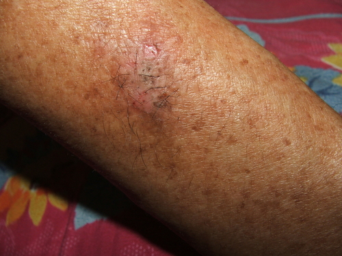 Pemfigo volgare: marcatori immunologici predicono recidiva