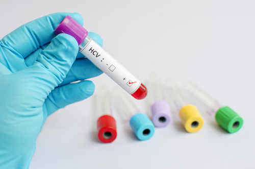 Epatite C: per gli over 65 efficace la combinazione Ledipasvir-Sofosbuvir