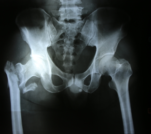 Artrosi dell’anca: il plasma ricco di piastrine non allevia il dolore più di un placebo 