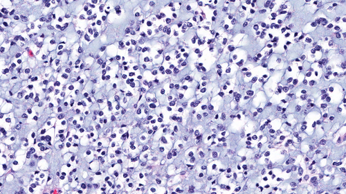 Glioblastoma: resezione massima migliora sopravvivenza