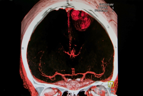 Ictus: trombectomia endovascolare meglio della trombolisi farmacologica
