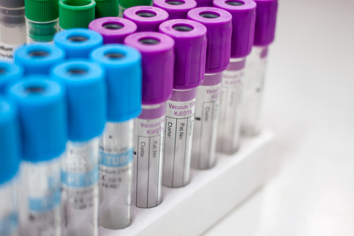 Tumori ovarici: più diagnosi del previsto con ter CA125