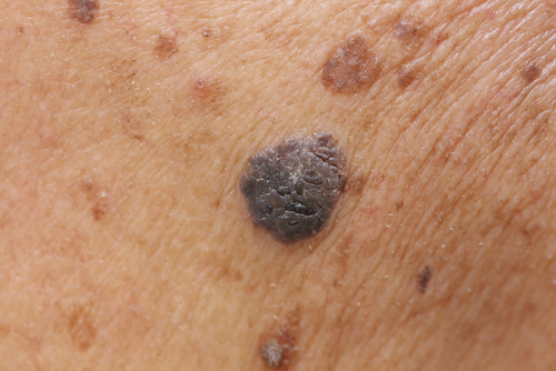 Melanoma: con la Total Body Photography meno biopsie