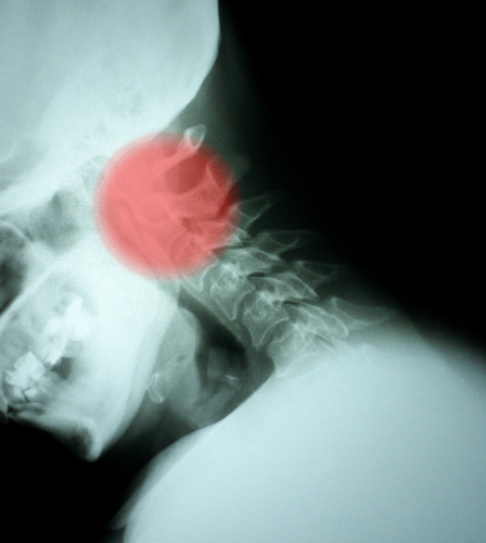 Cancro squamocellulare della testa e del collo: valore prognostico dei linfociti infiltranti il ​​tumore