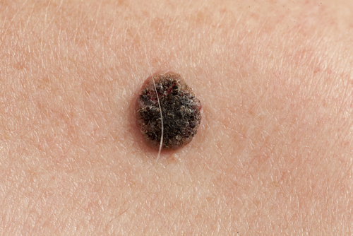 Ruoli e formazione degli infermieri nello screening dei tumori della pelle