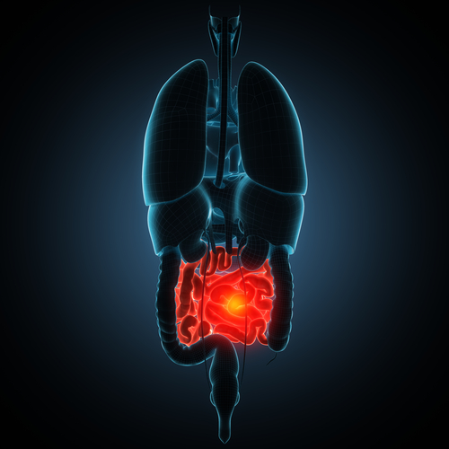 Fattori di rischio di manifestazioni extraintestinali nelle IBD