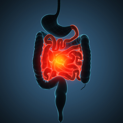 Idradenite suppurativa associata a malattie infiammatorie intestinali