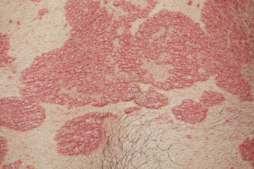 Psoriasi: rischio aneurisma aorta addominale legato a gravità della malattia