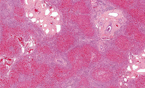 Sindrome dell’intestino corto: elastografia ARFI utile per valutare malattia epatica nei bambini