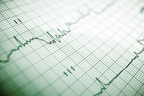Impatto dell’epatite ipossica sulla prognosi dei pazienti sopravvissuti ad arresto cardiaco