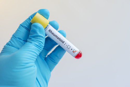 Artrite reumatoide: dagli anticorpi un possibile screening per la popolazione