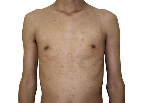 Pitiriasi versicolor e stress ossidativo e nitrosativo