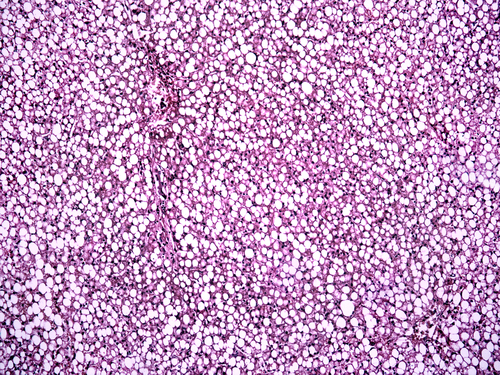 Malattia di Gaucher: steatosi epatica altamente prevalente e associata a fibrosi