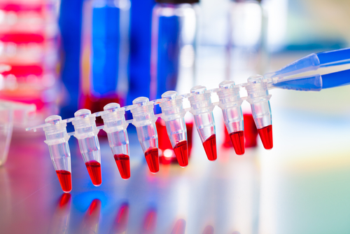 Mieloma multiplo: significato di RB1