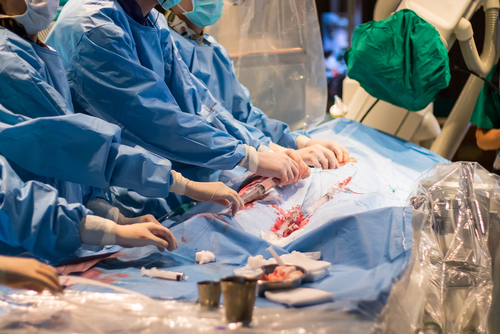 PCI: approccio radiale non riduce sopravvivenza rispetto a quello femorale