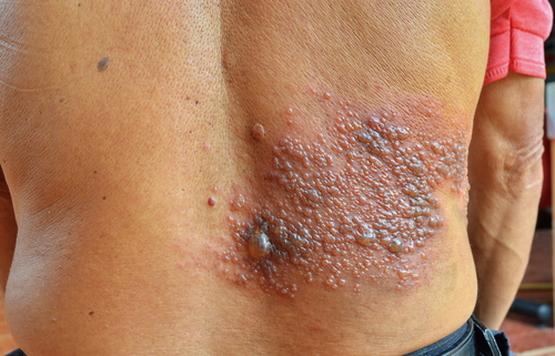 Zoster: nuovo vaccino più efficace negli anziani