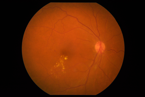 Retinopatia diabetica: pochi pazienti fanno i controlli