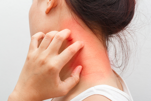 Livelli di S. aureus nella cute e prurito nella dermatite atopica