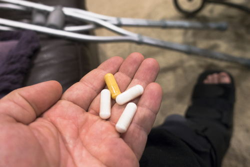 Chirurgia terzo molare: efficace bromelaina nel post-operatorio