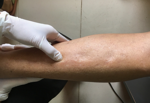 Linfedema e tumore mammario: dove si trova il massimo rischio?