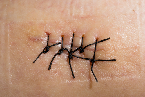 Ferite chirurgiche: gli antibiotici a effetto topico non accelerano la guarigione