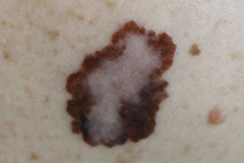 Melanoma metastatico: anti-PD-1 migliori in prima linea?