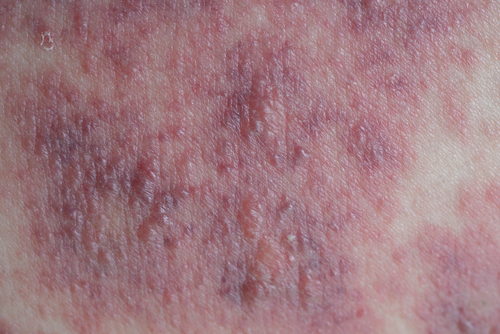 Dermatite atopica e controllo percepito dal paziente: lo strumento ADCT