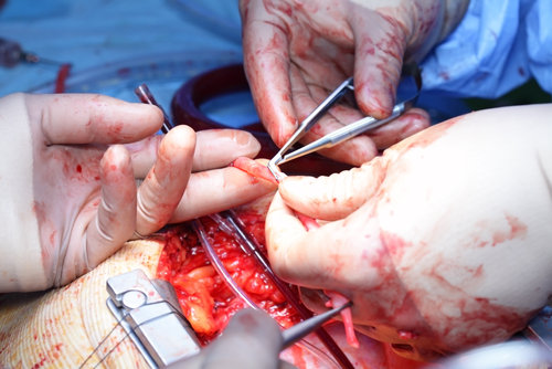 Cardiochirurgia: ulcere duodenali causano emorragie gastrointestinali