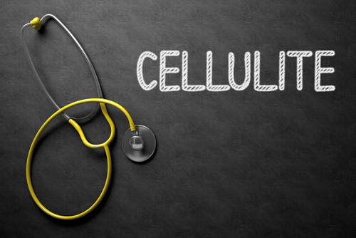 Cellulite: diagnosi errata comune e costosa