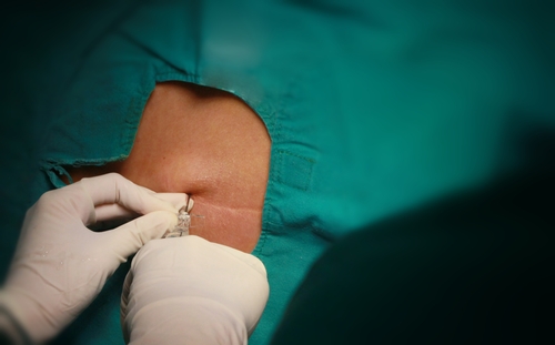 Iniezioni spinali per la gestione del dolore