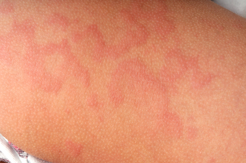 Orticaria idiopatica: omalizumab migliora angioedema e qualità della vita