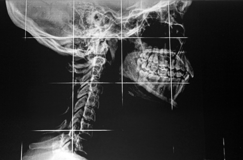 Cifosi cervicale ed alterazioni di struttura e dinamiche faringee