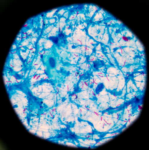 TBC polifarmacoresistente: trasmissione interpersonale alimenta epidemia