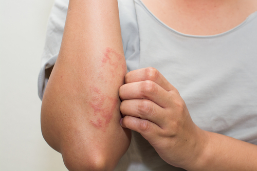 Eczema: nuovo biologico potenziale punto di svolta
