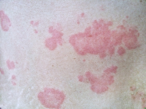 Dermatite atopica: da forma acuta a cronica, cambiamenti più di tipo quantitativo che qualitativo