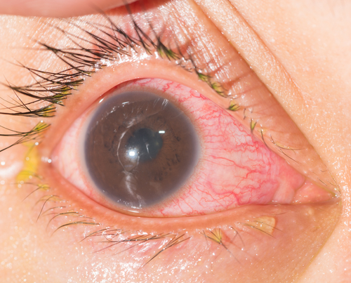 Covid: vaccinazione precoce vs differita tra pazienti con una storia di uveite