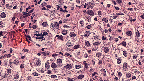 Vaccini multipeptidici per il melanoma: risultati di uno studio di fase II