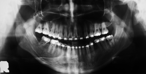 Chirurgia ortognatica: incidenza e fattori di rischio per la rimozione delle piastre