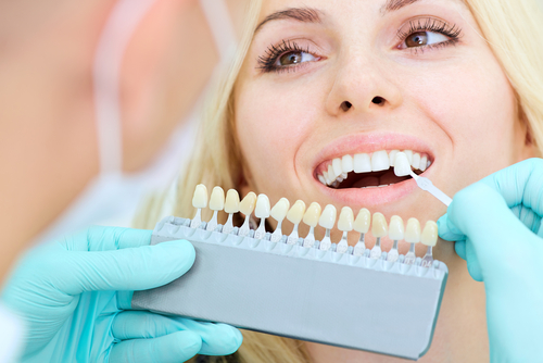 Sbiancanti dentali: effetti a lungo termine sullo smalto dei denti umani